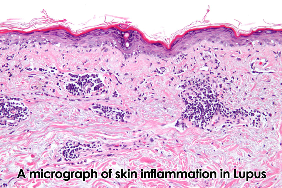 Early Diagnosis and Treatment of Discoid Lupus Erythematosus