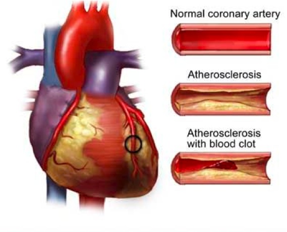 Arterial Disease