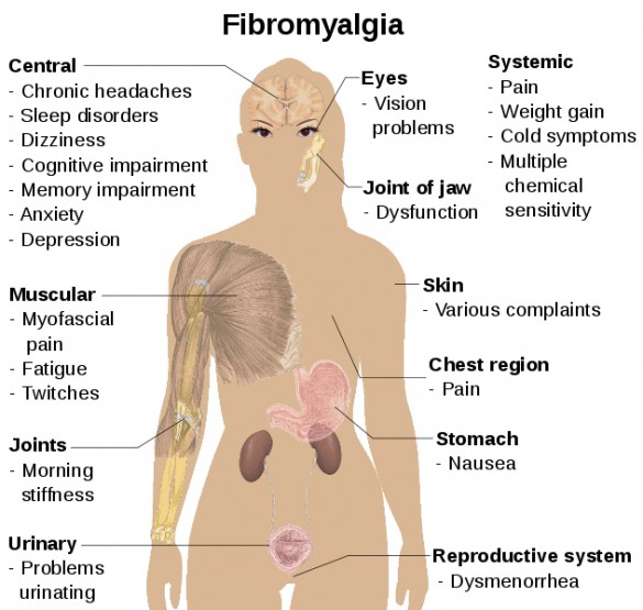 fibromyalgia