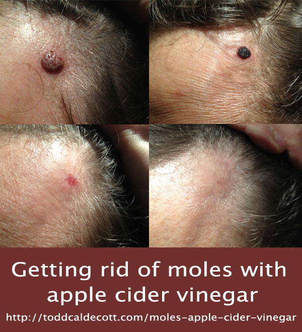 moles_ACV