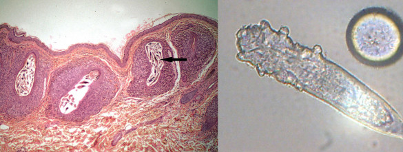 Demodex