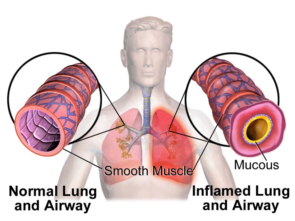 Chronic Bronchitis Meaning In Tamil